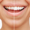 composite dental veneers