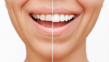 composite dental veneers