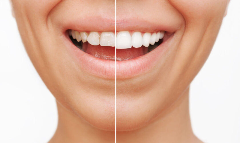 composite dental veneers