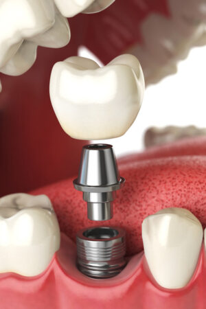 Dental Implants